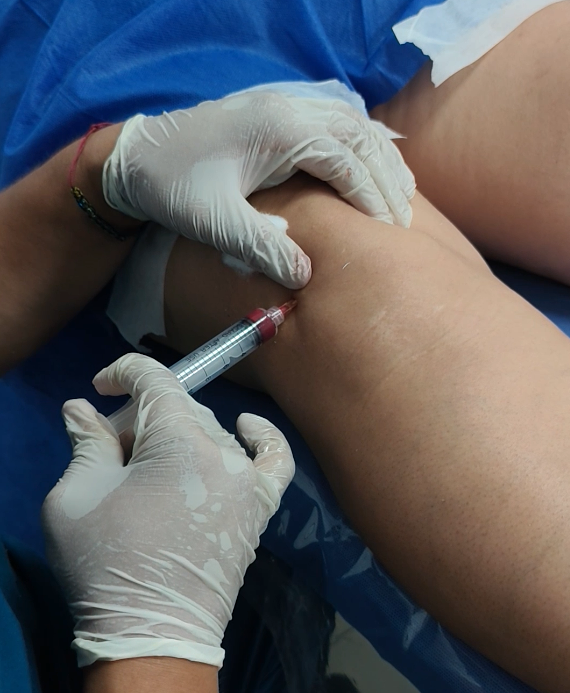 Infiltración directa de rodilla